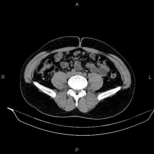 Adrenal myelolipoma (Radiopaedia 87794-104246 Axial non-contrast 68).jpg