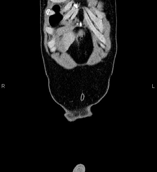 File:Adrenal myelolipoma (Radiopaedia 87794-104246 Coronal renal cortical phase 1).jpg