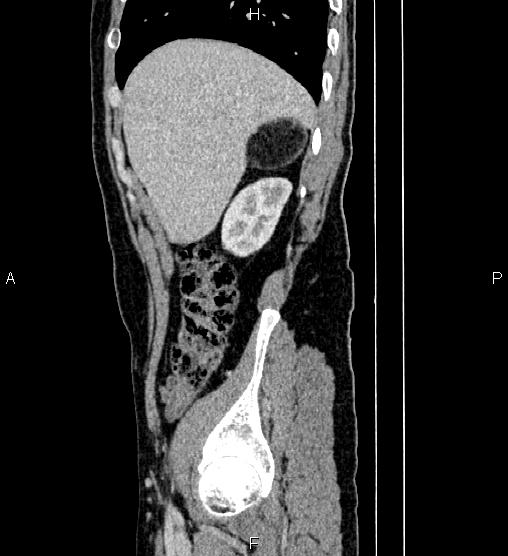 Adrenal myelolipoma (Radiopaedia 87794-104246 Sagittal renal cortical phase 19).jpg