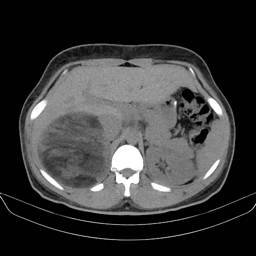 Adrenal myelolipoma - bilateral (Radiopaedia 74805-85810 Axial non-contrast 20).jpg