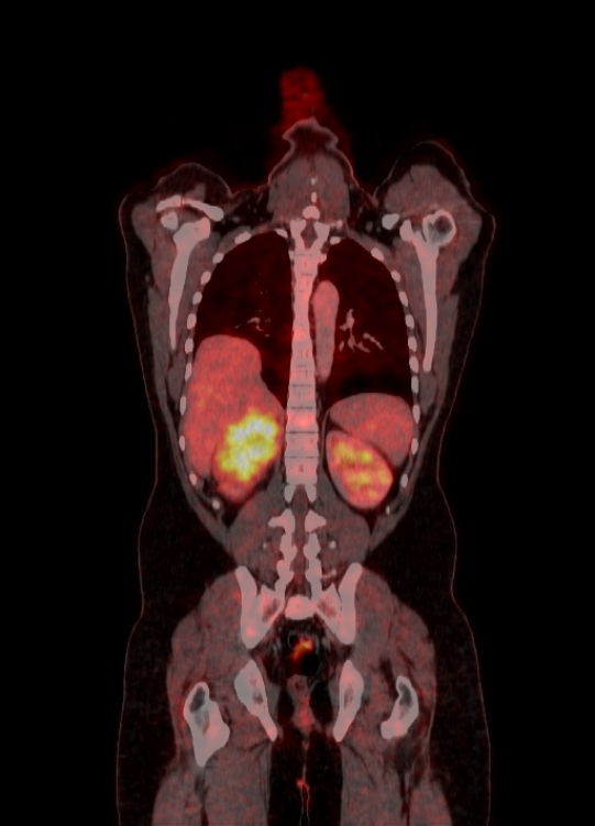 Adrenocortical carcinoma (Radiopaedia 80134-93440 Coronal 137).jpg