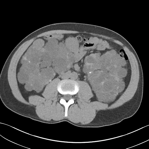 File:Adult polycystic kidney disease (Radiopaedia 47866-52626 Axial non-contrast 42).png