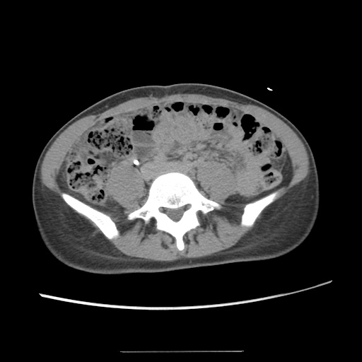 Adult polycystic kidney disease (Radiopaedia 48845-53876 Axial renal excretory phase 60).jpg