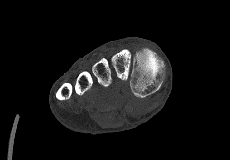 Advanced osteomyelitis due to open metatarsal fracture (Radiopaedia 83891-99095 Axial bone window 29).jpg