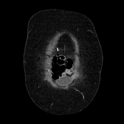 File:Afferent loop syndrome - secondary to incarcerated trocar site hernia (Radiopaedia 82959-97305 Coronal C+ portal venous phase 25).jpg