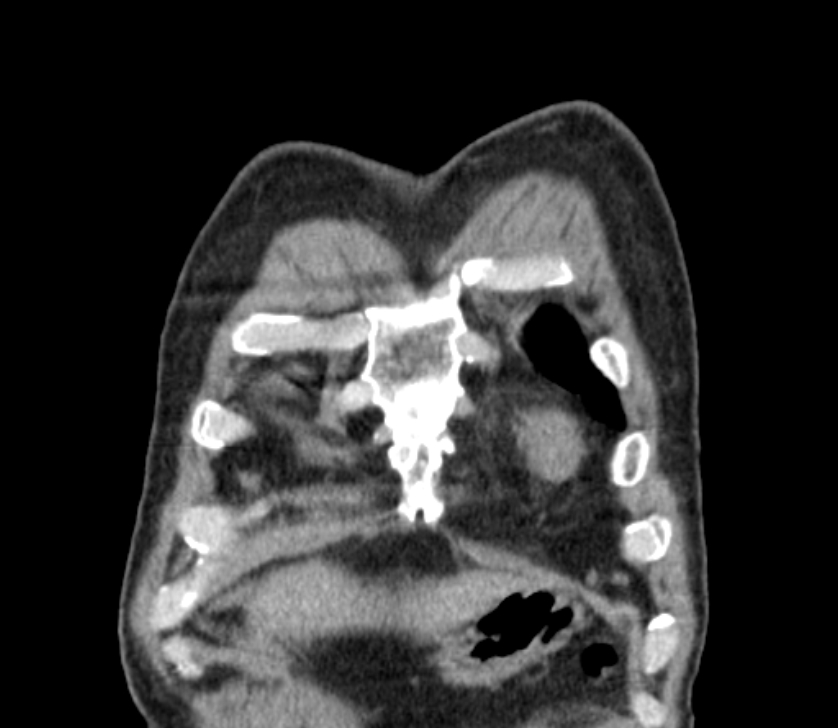 Airway foreign body in adult (Radiopaedia 85907-101779 Coronal liver window 14).jpg
