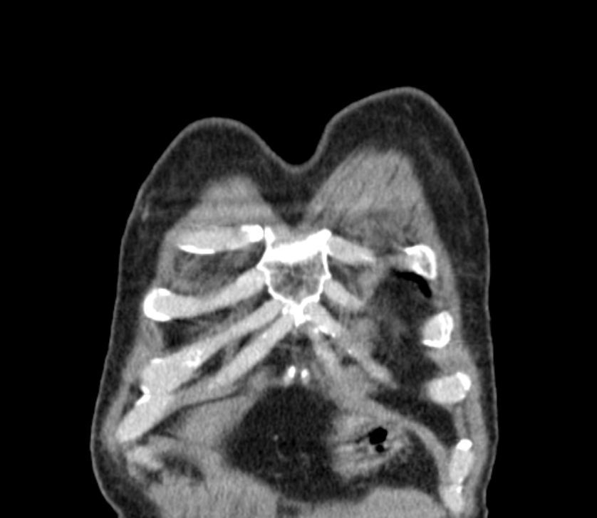 Airway foreign body in adult (Radiopaedia 85907-101779 Coronal liver window 8).jpg
