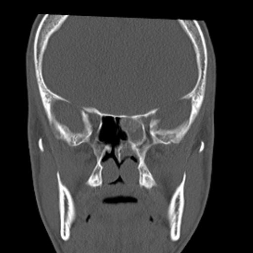 File:Allergic fungal sinusitis (Radiopaedia 29086-29455 Coronal bone window 8).jpg