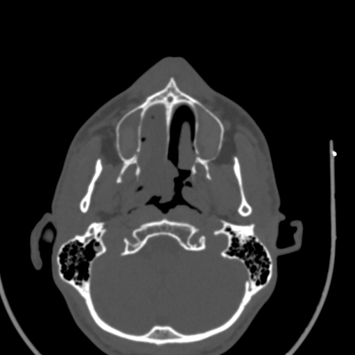 Allergic fungal sinusitis (Radiopaedia 88725-105456 Axial bone window 9).jpg