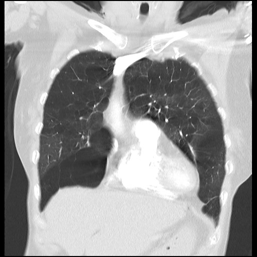 File:Alpha-1-antitrypsin deficiency (Radiopaedia 64893-73840 Coronal lung window 9).jpg