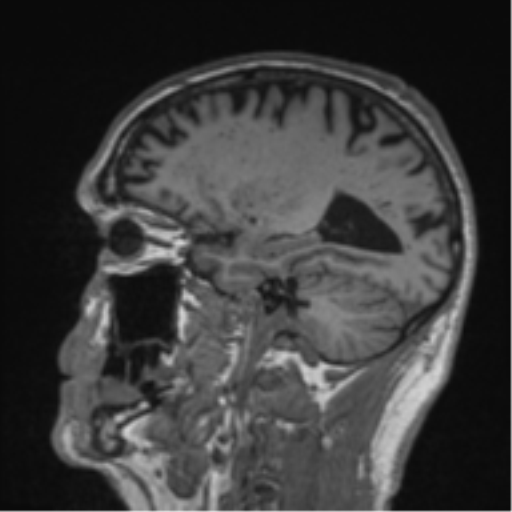 File:Alzheimer's disease- with Gerstmann syndrome and dressing apraxia (Radiopaedia 54882-61150 Sagittal T1 21).png