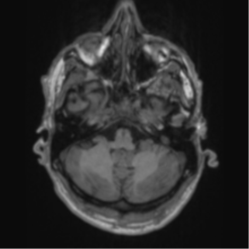 Alzheimer's disease- with apraxia (Radiopaedia 54763-61011 Axial T1 16).png