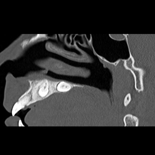 File:Ameloblastic fibro-odontoma (Radiopaedia 18843-18780 bone window 3).jpg