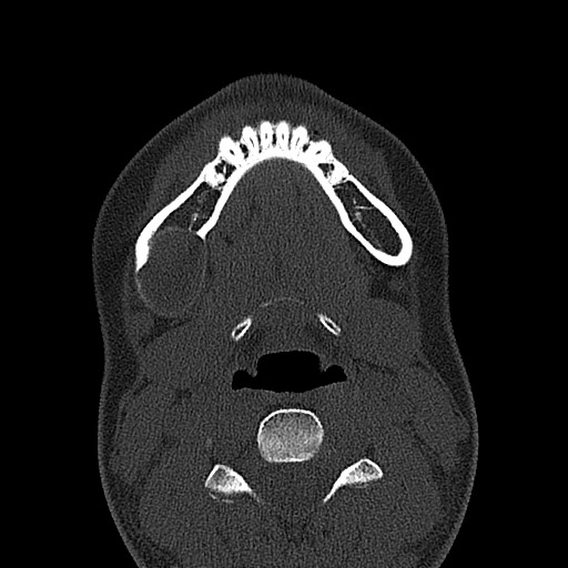 File:Ameloblastoma (Radiopaedia 26645-26793 E 18).jpg