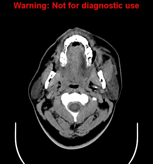 File:Ameloblastoma (Radiopaedia 33126-34164 A 3).jpg