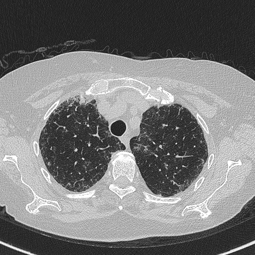 Amiodarone-induced pulmonary fibrosis (Radiopaedia 82355-96460 Axial lung window 16).jpg
