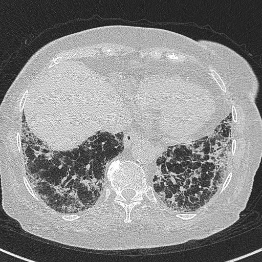 File:Amiodarone-induced pulmonary fibrosis (Radiopaedia 82355-96460 Axial lung window 54).jpg