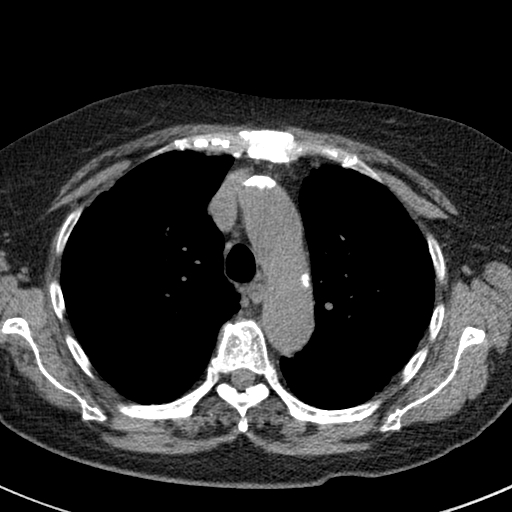 File:Amiodarone-induced pulmonary fibrosis (Radiopaedia 82355-96460 Axial non-contrast 22).jpg