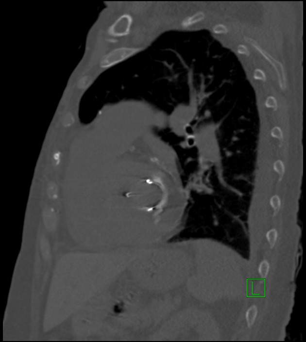 Amiodarone deposition in the liver (Radiopaedia 77587-89780 Sagittal bone window 36).jpg
