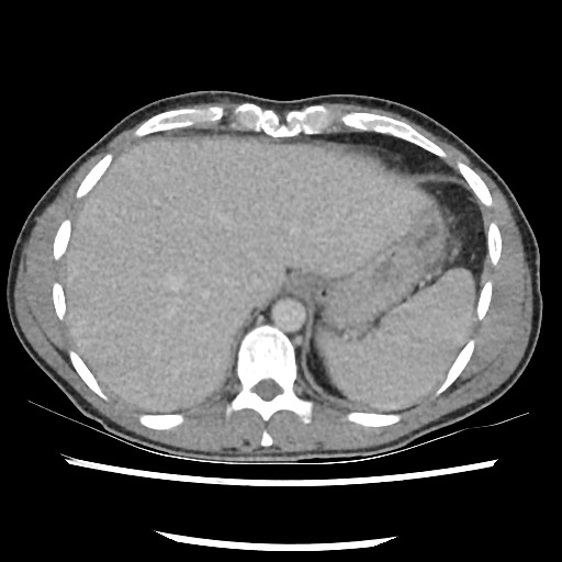 File:Amoebic liver abscesses (Radiopaedia 55536-62010 A 17).jpg