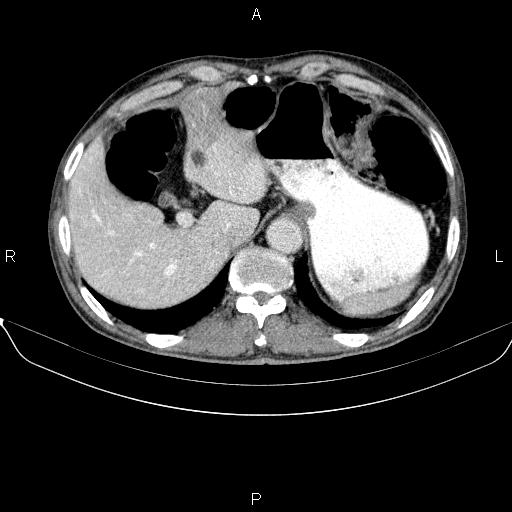 Ampullary adenocarcinoma (Radiopaedia 86093-102032 A 14).jpg
