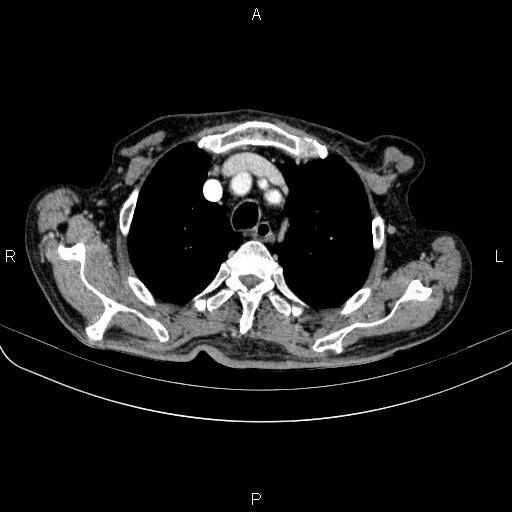 Ampullary adenocarcinoma (Radiopaedia 86093-102033 B 20).jpg