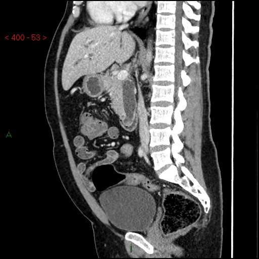 File:Ampullary carcinoma (Radiopaedia 56396-63056 D 52).jpg