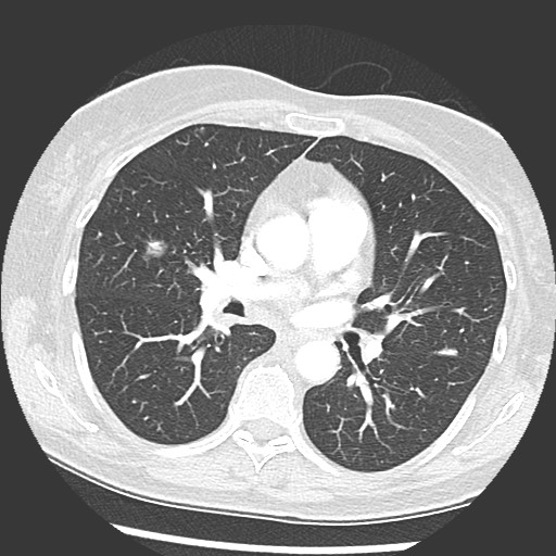 Amyloidosis - bronchial and diffuse nodular pulmonary involvement (Radiopaedia 60156-67745 Axial lung window 39).jpg