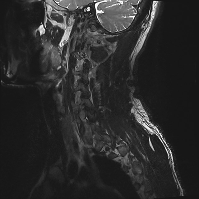 Amyotrophic lateral sclerosis (Radiopaedia 87352-103658 I 61).jpg