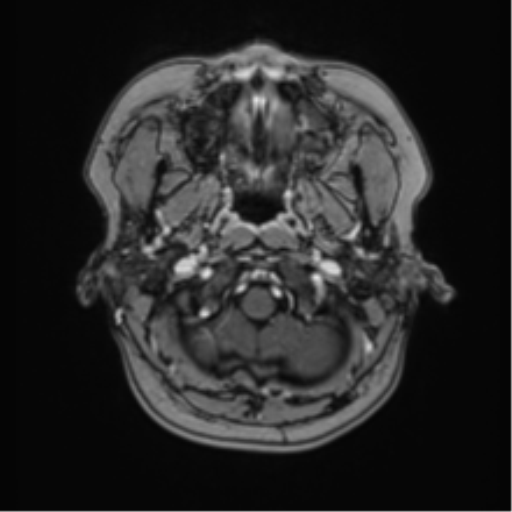 Anaplastic astroblastoma (Radiopaedia 55666-62194 Axial T1 C+ 7).png