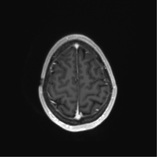 File:Anaplastic astrocytoma IDH mutant (Radiopaedia 50046-55341 Axial T1 C+ 42).png