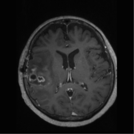File:Anaplastic astrocytoma IDH wild-type (pseudoprogression) (Radiopaedia 42209-45277 Axial T1 C+ 70).png