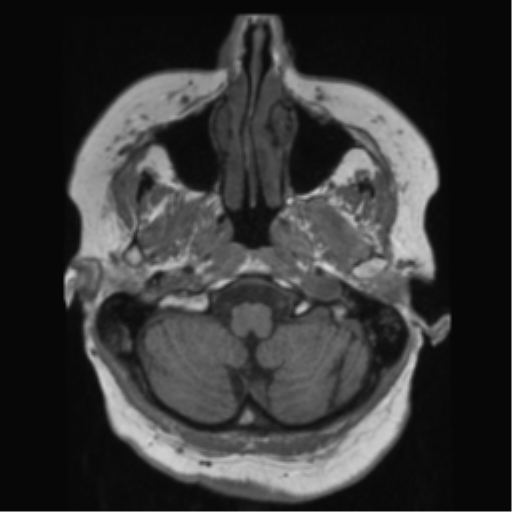 File:Anaplastic astrocytoma IDH wild-type (pseudoprogression) (Radiopaedia 42209-45278 Axial T1 31).png