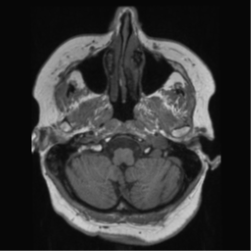 File:Anaplastic astrocytoma IDH wild-type (pseudoprogression) (Radiopaedia 42209-45278 Axial T1 33).png