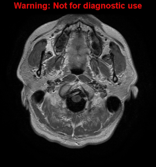 File:Anaplastic ganglioglioma (Radiopaedia 44921-48831 Axial T1 C+ 1).jpg