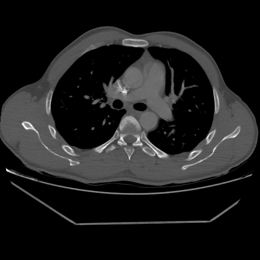 Aneurysmal bone cyst - rib (Radiopaedia 82167-96220 Axial bone window 118).jpg