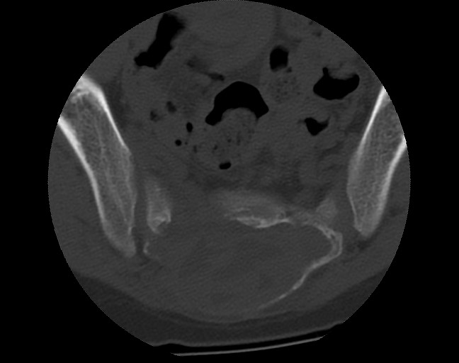 Aneurysmal bone cyst - sacrum (Radiopaedia 65190-74195 Axial bone window 29).jpg