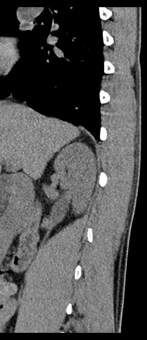 Aneurysmal bone cyst T11 (Radiopaedia 29294-29721 E 67).jpg