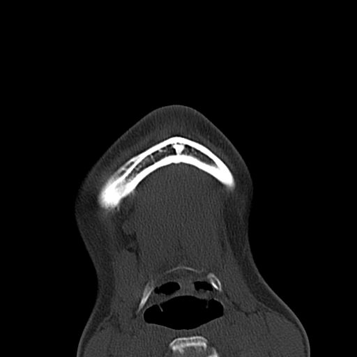 Aneurysmal bone cyst of the mandible (Radiopaedia 43280-46601 Axial bone window 1).jpg