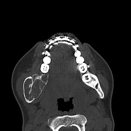 Aneurysmal bone cyst of the mandible (Radiopaedia 43280-46601 Axial bone window 30).jpg