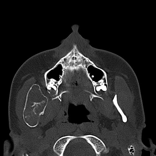 Aneurysmal bone cyst of the mandible (Radiopaedia 43280-46601 Axial bone window 55).jpg