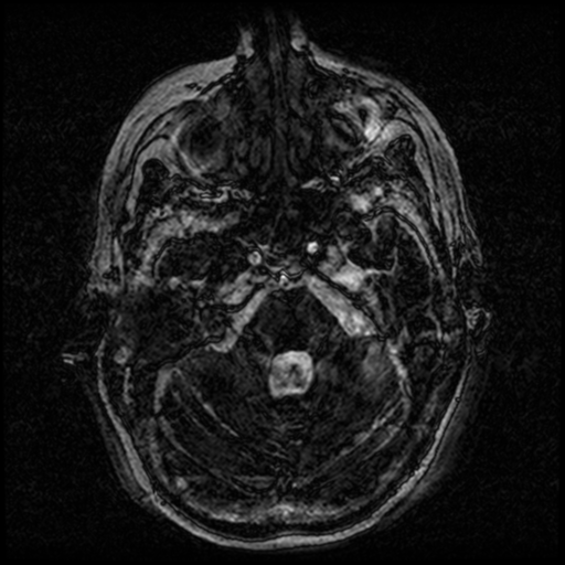 Angioinvasive aspergillosis in the pituitary fossa (Radiopaedia 39676-42010 Ax 3D FIESTA VOLUME 19).png