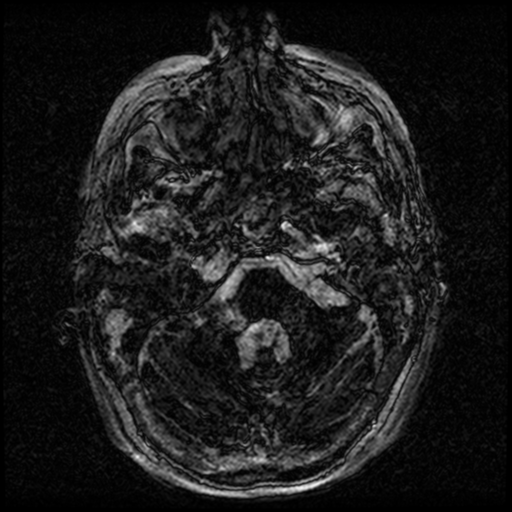 Angioinvasive aspergillosis in the pituitary fossa (Radiopaedia 39676-42010 Ax 3D FIESTA VOLUME 9).png