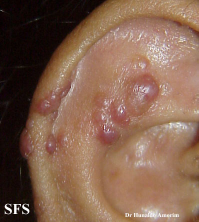 Angiolymphoid Hyperplasia With Eosinophilia (Dermatology Atlas 2).jpg