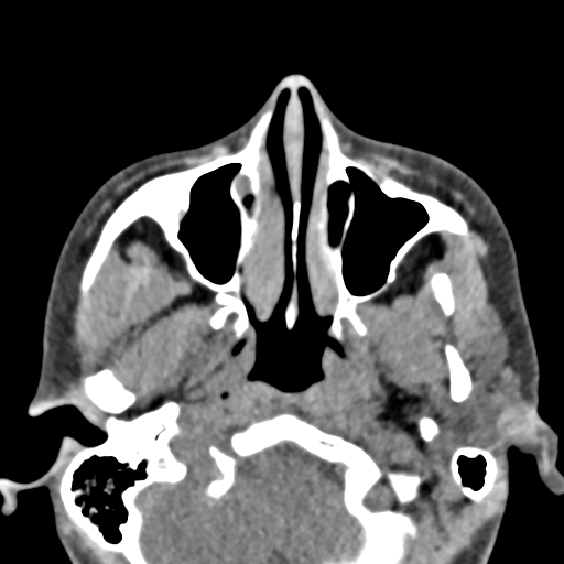 Angular dermoid cyst (Radiopaedia 88967-105790 Axial non-contrast 15).jpg