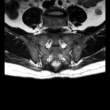 File:Ankylosing spondylitis with zygapophyseal arthritis (Radiopaedia 38433-40517 C 9).jpg
