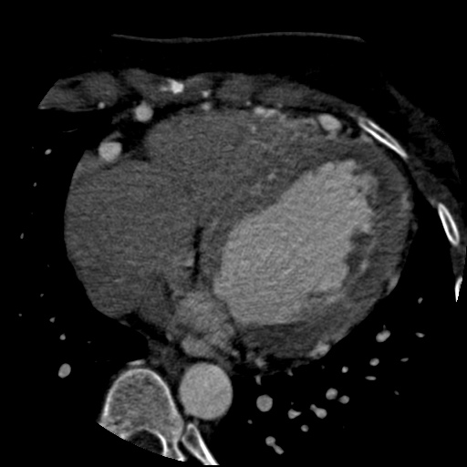 File:Anomalous left coronary artery from the pulmonary artery (ALCAPA) (Radiopaedia 40884-43586 A 54).jpg