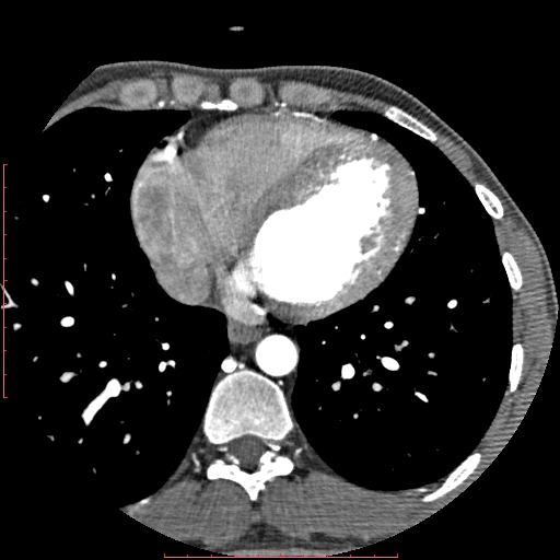 File:Anomalous left coronary artery from the pulmonary artery (ALCAPA) (Radiopaedia 70148-80181 A 245).jpg