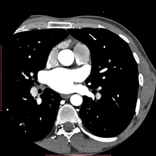 Anomalous left coronary artery from the pulmonary artery (ALCAPA) (Radiopaedia 70148-80181 A 74).jpg