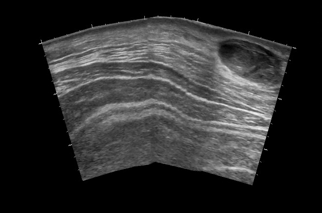 File:Anterior abdominal wall hematoma (Radiopaedia 11069-11472 C 1).jpg